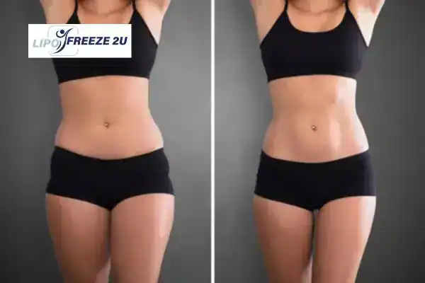 How Can LIPO FREEZE 2U Support Your Post-Pregnancy Body Recovery Berkshire?