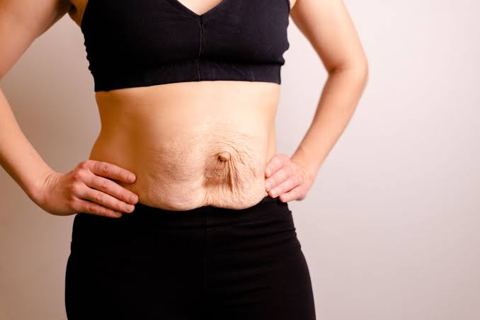 Is Surgery Really the Only Way to Repair Diastasis Recti Berkshire?