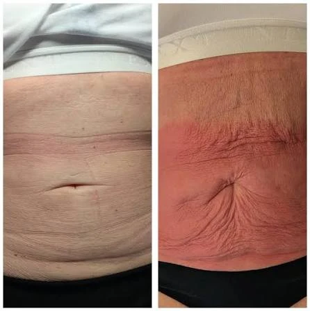 How Does RF Microneedling Improve Crepey, Thin and Uneven Skin Texture Berkshire?