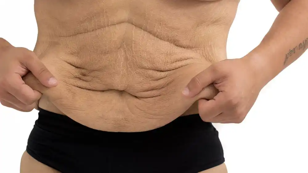 Why Does Weight Loss Medication Leave Some People With Loose or Sagging Skin Berkshire?